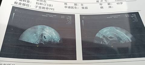 甘肃兰州太和医院供卵试管婴儿的成功率是多少？