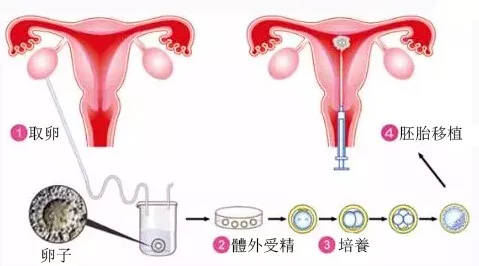 试管婴儿享受生育险