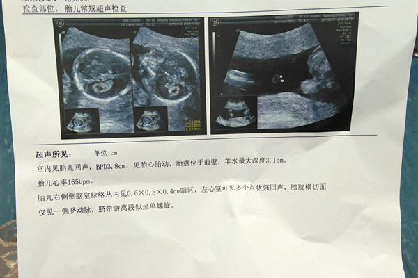 孕期超声显示胎儿头大腿短,出生后如何进一步检查？