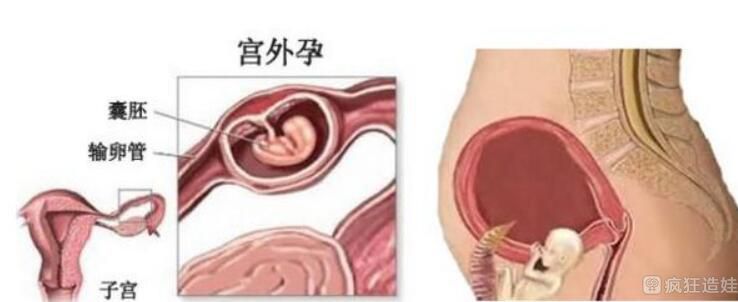 代生试管生女孩取卵无论大小都取吗？
