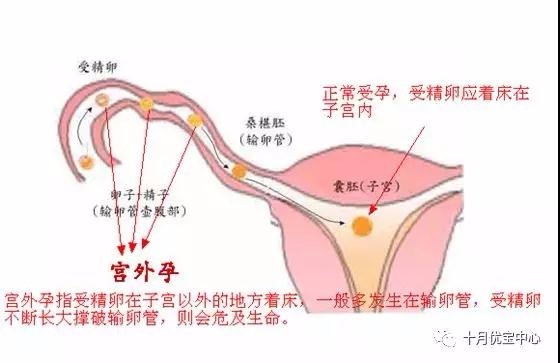 甘肃第三代试管适应人群包括多囊卵巢综合征患者吗